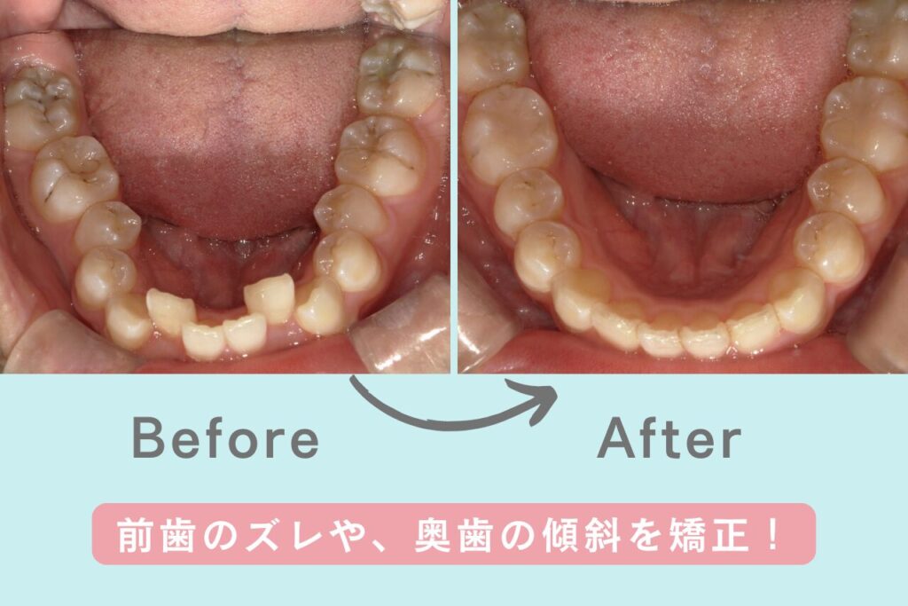 前歯のズレや、奥歯の傾斜を矯正したビフォーアフター