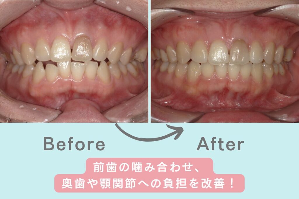 前歯の噛み合わせ、奥歯や顎関節への負担を矯正で改善
